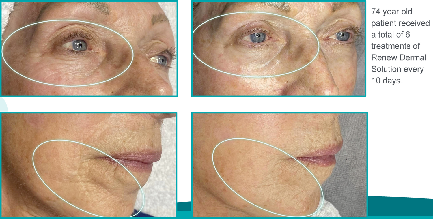 Renew_Dermal_Solution_Treatment_Before_And_After_Six_Treatments