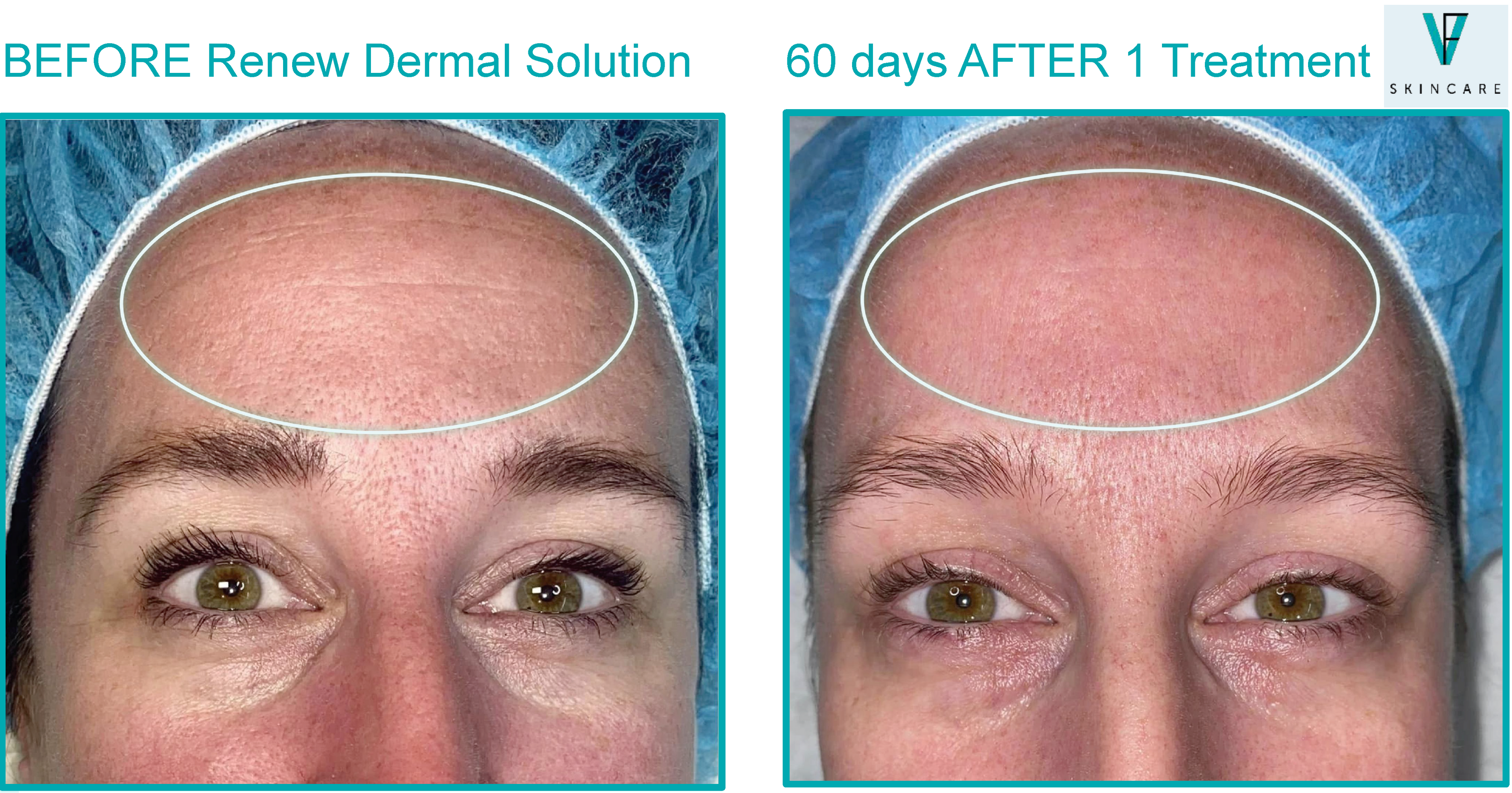 Renew_Dermal_Solution_Treatment_Before_And_After_One_Treatment